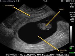 Ultrasound Basics How To Read An Ultrasound Image Diagnostic Medical Sonography Ultrasound Sonography