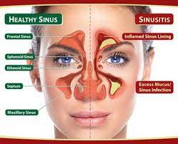 We did not find results for: Have Your Sinus Allergies Turned Into An Infection Houston Sinus Surgery Ear Nose Throat Doctors