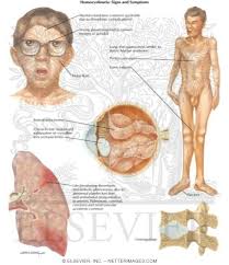 Image result for Homocystinuria