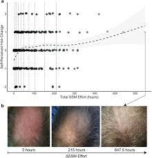Scalp massages can be done with or without oils or conditioners depending on your regimen, and at least ten minutes once a day is a good guideline. Self Assessments Of Standardized Scalp Massages For Androgenic Alopecia Survey Results Springerlink