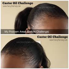 In fact, there have been a lot of instances where people have developed dermatitis after using castor oil. Castor Oil For Hair