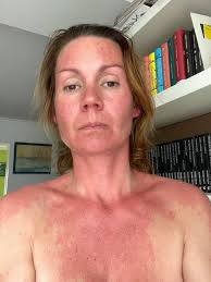 Tak jsem ve 44 letech zjistila, že jsem zřejmě alergická na žlutoploutvého  tuňáka (koupen dnes v Lidlu