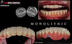 Why Settle For Less With Solid Monolithic Full Strength Zirconia You Will Have Better Esthetics Better Function Easy To Cle Esthetics Dental Laboratory Dental