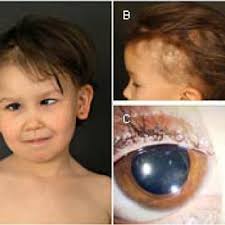 PDF) Conradi-Hünermann-Happle Syndrome (X-linked Dominant Chondrodysplasia  Punctata) Confirmed by Plasma Sterol and Mutation Analysis