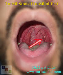 Image result for Tonsillolith