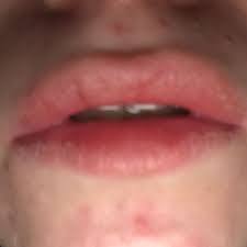 Trockene Brennende Und Rote Lippen Was Soll Ich Tun Brennen