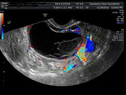 Treatments for ovarian cancer are improving, and the best outcomes are always seen when the cancer is found early. Ovarian Cysts