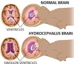 Pediatric Hydrocephalus Http Www Columbianeurosurgery Org Conditions Pediatric Hydrocephalus Pediatrics Pediatric Nursing Nursing Study Tips