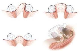 Resultado de imagem para vacuo endermologia