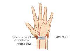 My ring finger on my right hand has been a little stiff and achey for the few days and this morning i woke up to it extremely swollen. Ulnar Nerve Entrapment Causes And Symptoms