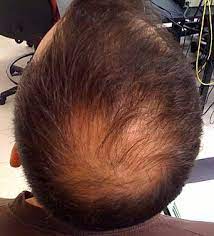 Female hair thinning at the crown or top of the head can widen the middle hair part slowly. Hair Loss Wikipedia