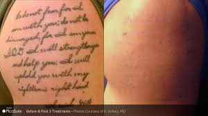 Bbb directory of tattoo removal near medford, ny. Tattoo Removal Chicago Tattoo Design