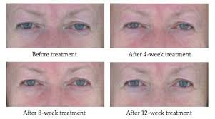 Biossance Squalane Phyto Retinol Serum Pregnancy All About Sytenol A In Remarkable Revivinol Serum Revivserums Com