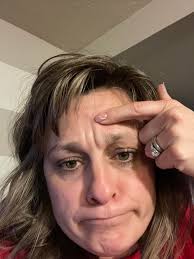 Has anyone here experience having pimple breakouts at the back ?