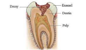 Tooth Decay