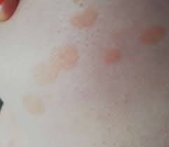 Was Sind Das Fur Komische Braune Flecken Gesundheit Und Medizin Gesundheit Medizin