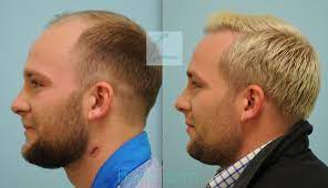Pin By Hairtx On Male Hair Transplant Results Hair Transplant Hair Transplant Results Mens Hairstyles