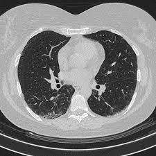 Rheumatoid Interstitial Lung Disease Moderate Radiology Case Radiopaedia Org