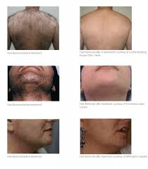Hair enters that growth phase at different times, so multiple sessions will be required to finally address all the hair follicles in the treated area. Cheshire Lasers Ipl And Laser Hair Removal Middlewich Cheshire