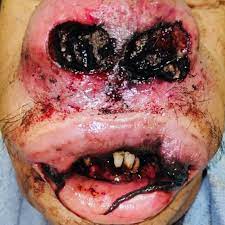 Worldwide, the most common flies that cause the human infestation are dermatobia hominis (human botfly) and cordylobia anthropophaga (tumbu fly). Massive Airway Myiasis An Extreme Rarity Bmj Case Reports