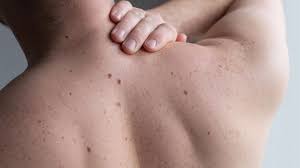 Image result for Solar Lentigo