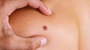 There are many different types of skin diseases, but some of the more common kinds are psoriasis, eczema, herpes simplex, lupus, acne, rosacea and skin cancer. à¤¸ à¤• à¤¨ à¤• à¤¸à¤° à¤• à¤¯ à¤¹ à¤‡à¤¸à¤• à¤²à¤• à¤·à¤£ à¤µ à¤‡à¤² à¤œ à¤¸ à¤• à¤¨ à¤• à¤¸à¤° à¤¸ à¤• à¤¸ à¤¬à¤š à¤œ à¤¸à¤•à¤¤ à¤¹