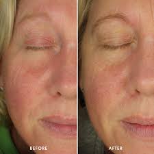 Image result for Azelaic Acid