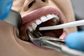 Your colleges will get your scores within 10 days after you receive them (if you've indicated them as score recipients). Tooth Extraction When Will Dentists Pull Teeth Dr Varley
