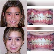 *read me*okay so i know that i took a lot of pictures at the beginning of my treatment, but that's when the changes were most drastic. Before After Braces Wazio Orthodontics