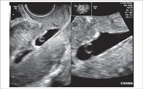 We did not find results for: Transvaginal Ultrasound Image Of A Cesarean Scar Pregnancy At 6 Weeks Download Scientific Diagram