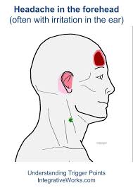 Fi Headache In The Forehead With Ear Irritation Trigger Points Headache Forehead Headache