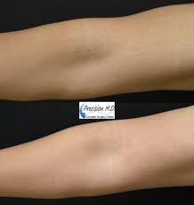 Different skin conditions can be specifically targeted the ktp and pulsed dye lasers are most often recommended for treating newly formed stretch marks that are still red or purple in color. Laser Stretch Mark Removal Sacramento Stretch Marks Treatment