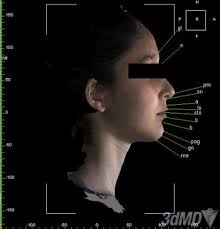 Evaluation of soft-tissue changes in young adults treated with the Forsus  fatigue-resistant device