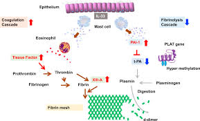 In rare cases, fungi can also give rise to this condition. Eosinophilic Chronic Rhinosinusitis Sciencedirect