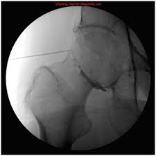 Image result for Hip Injection