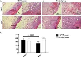 Maybe you would like to learn more about one of these? Negative Pressure Wound Therapy Promoted Wound Healing By Suppressing Inflammation Via Down Regulating Mapk Jnk Signaling Pathway In Diabetic Foot Patients Diabetes Research And Clinical Practice