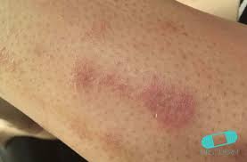 Utlag om involverar anikthuden kan oraka av infektioner, irritationer utslagets impetigo är en smittsam infektion som uppträder i småbarns och barns ansikte, enligt. Nummulart Eksem Mynteksem Hudlakare Pa Natet