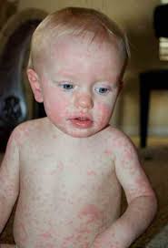 In young adults, the disease often results in fever, sore throat, enlarged lymph nodes in the neck, and tiredness. Mononucleosi Nei Bambini Riconoscerla E Curarla