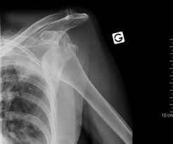 A second joint in the shoulder is the junction of the collar bone with the shoulder blade, called the acromioclavicular joint. The Shoulder Joint Structure Movement Teachmeanatomy