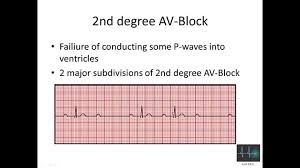 Ecg Cardiac Arrhythmias Youtube