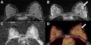 Patients who had baseline breast mri, mammography, and ultrasound examinations were included in this study; Pet Mri Identifies Notable Breast Cancer Imaging Biomarkers Eurekalert Science News