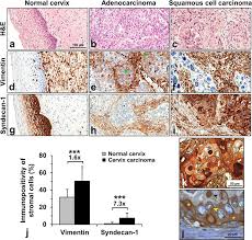 Check spelling or type a new query. Expression Of Vimentin And Syndecan 1 In Normal Cervix And Cervical Download Scientific Diagram