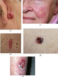Here are 10 more facts about prostate cancer. Recognising Skin Cancer In Primary Care Springerlink