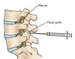 The lumbar spine makes up the the lower end of the spinal column. Spinal Injections Orthoinfo Aaos