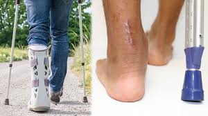 Timescales indicated are only a rough guide and you should. Residency Insight Can Patients With Achilles Tendon Ruptures Start Immediate Protected Weight Bearing And Accelerated Rehab Protocol