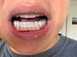 Is It Normal For Retainers To Do These To My Gums Just Got Them And They Are Tight Invisalign