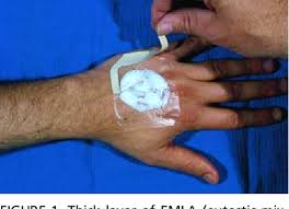 Image result for Local Skin Anesthesia