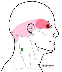 Neck Ache Headache Eye Ache Trigger Points Neck Ache Trigger Points Neck