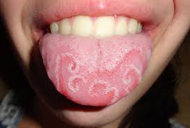 Read below for more information on other causes, related symptoms, and treatment options. Swollen Tongue A Minor Or Sometimes Dangerous Disorder Youmemindbody