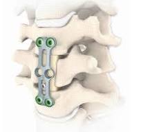 ATHLET® - Cervical vertebral body replacement from Signus ...